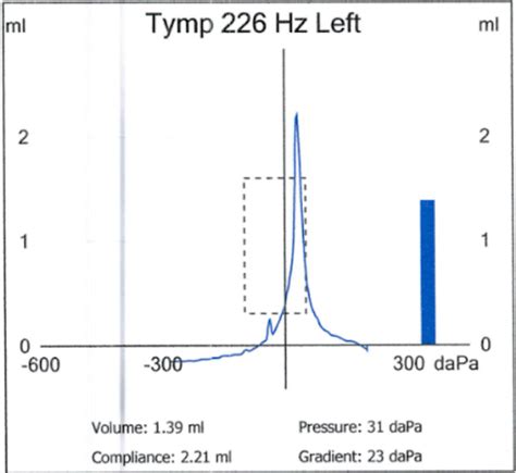 type a b c tympanogram|Tympanometry: What It Is and Types of Tympanogram Readings.